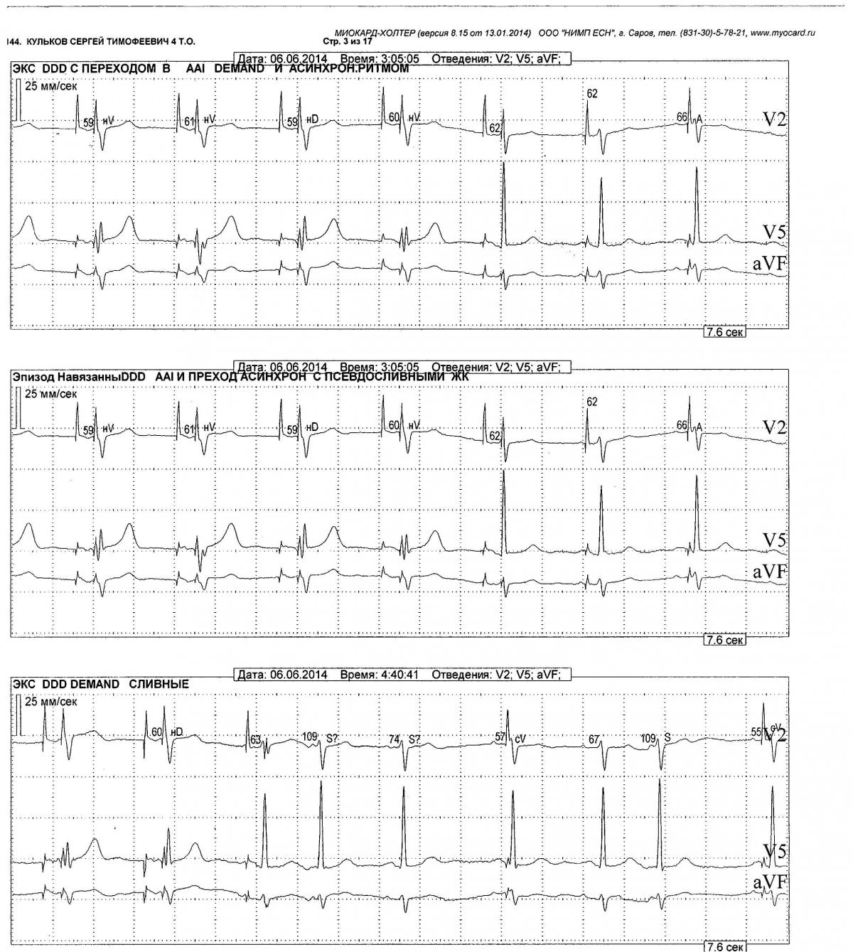 Дисфункция ЭКС - Вопросы участников форума - Аритмологический форум