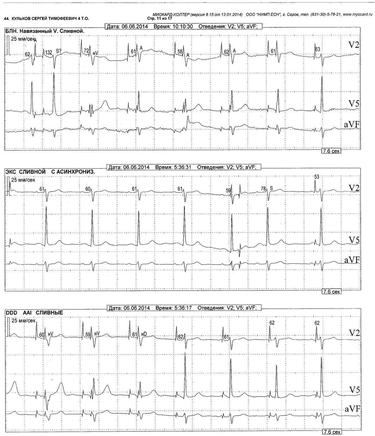 Дисфункция ЭКС - Вопросы участников форума - Аритмологический форум